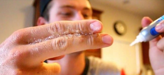Как избавиться от суперклея, застывшего на пальцах (5 фото)